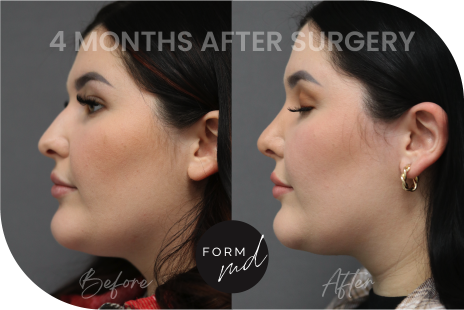 Before & After Gallery, Form MD Plastic Surgery, Facelift, Necklift
