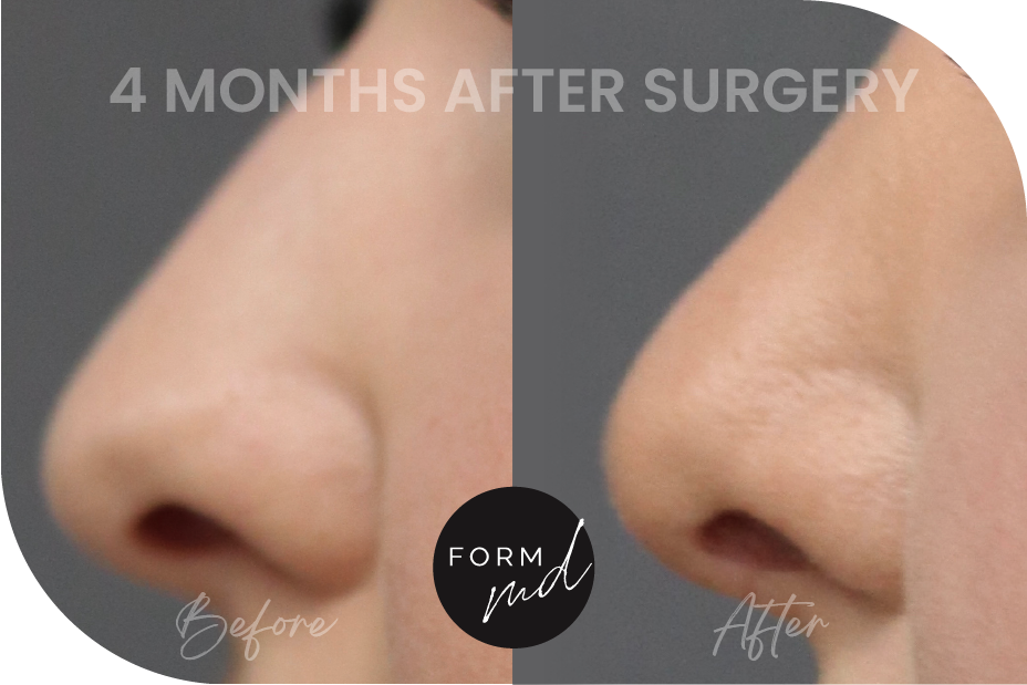 Form MD PS Before After Rhinoplasty Full Media_RP 2-08