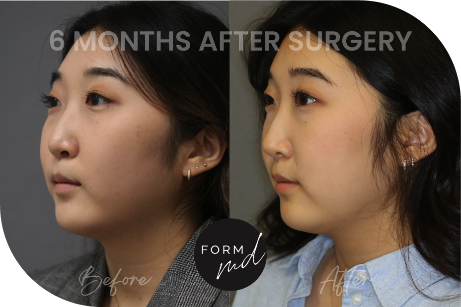 Form MD PS Before After Rhinoplasty Full Media_RP 5-21