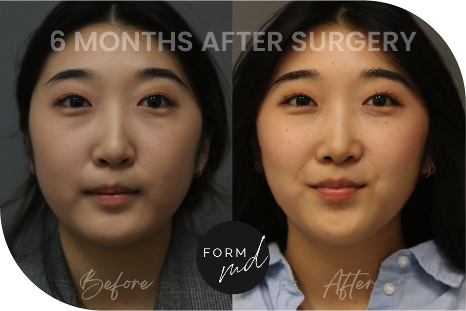 Form MD PS Before After Rhinoplasty Full Media_RP 5-22