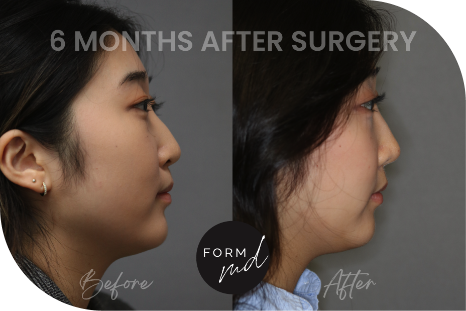 Form MD PS Before After Rhinoplasty Full Media_RP 5-23