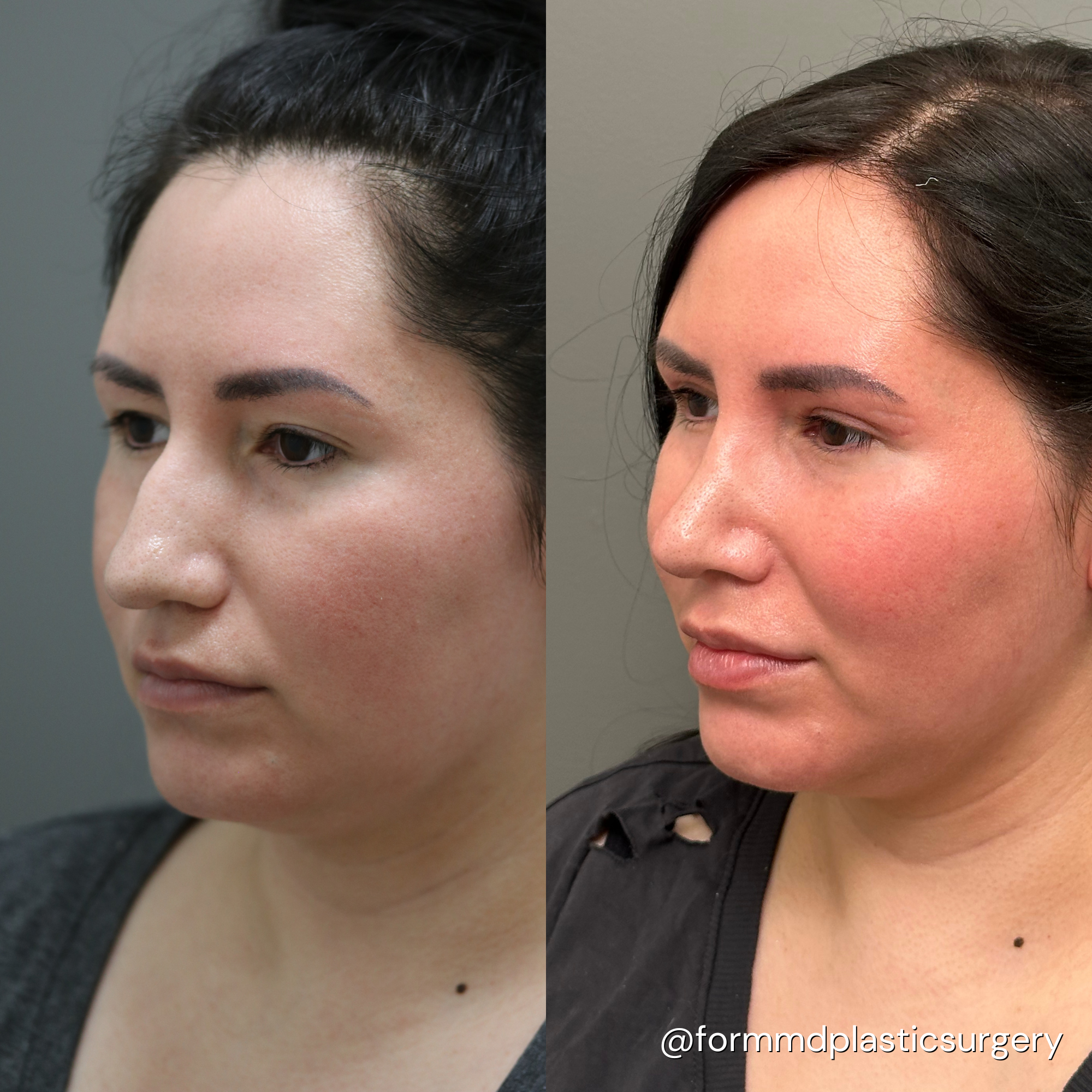 rhinoplasty results