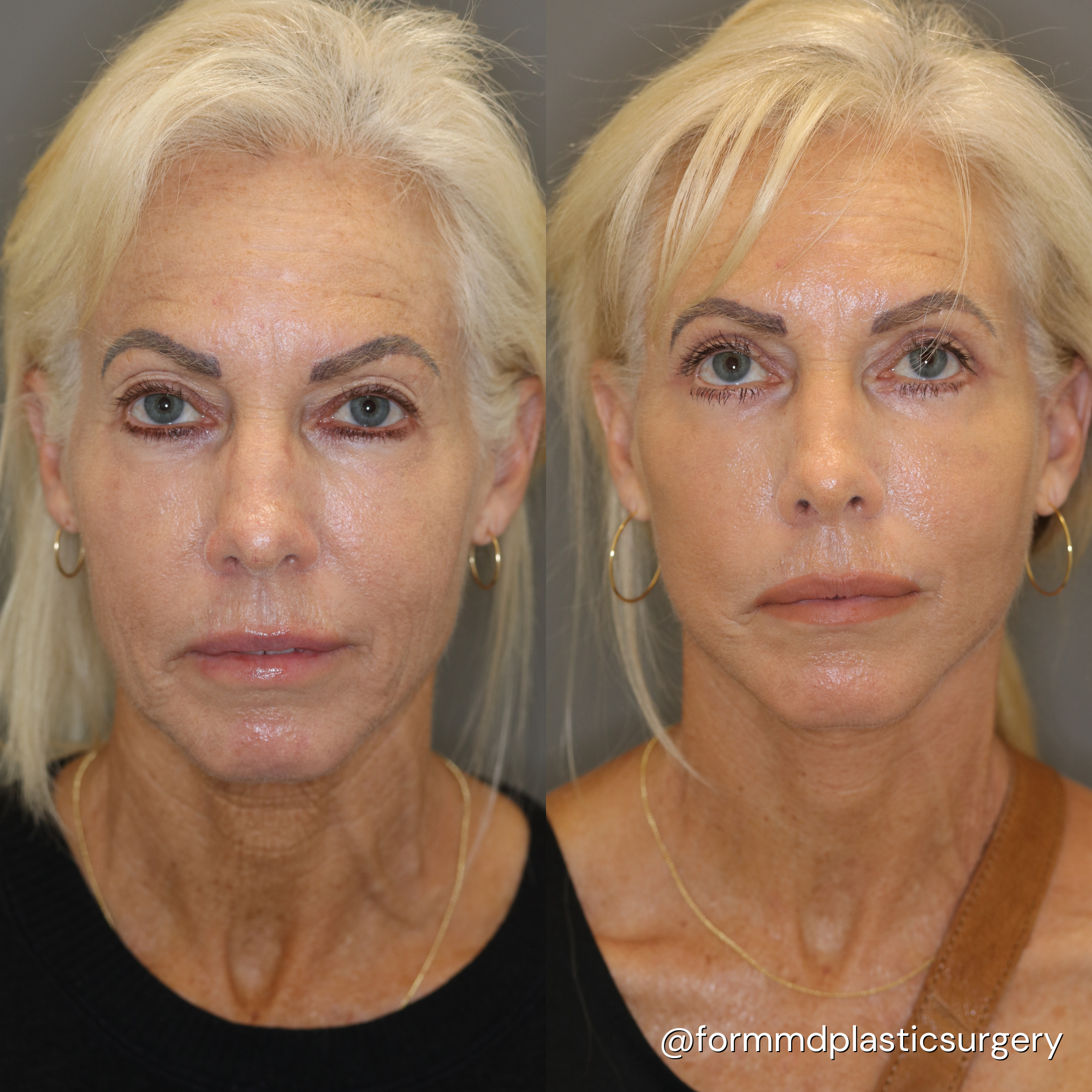 facelift results