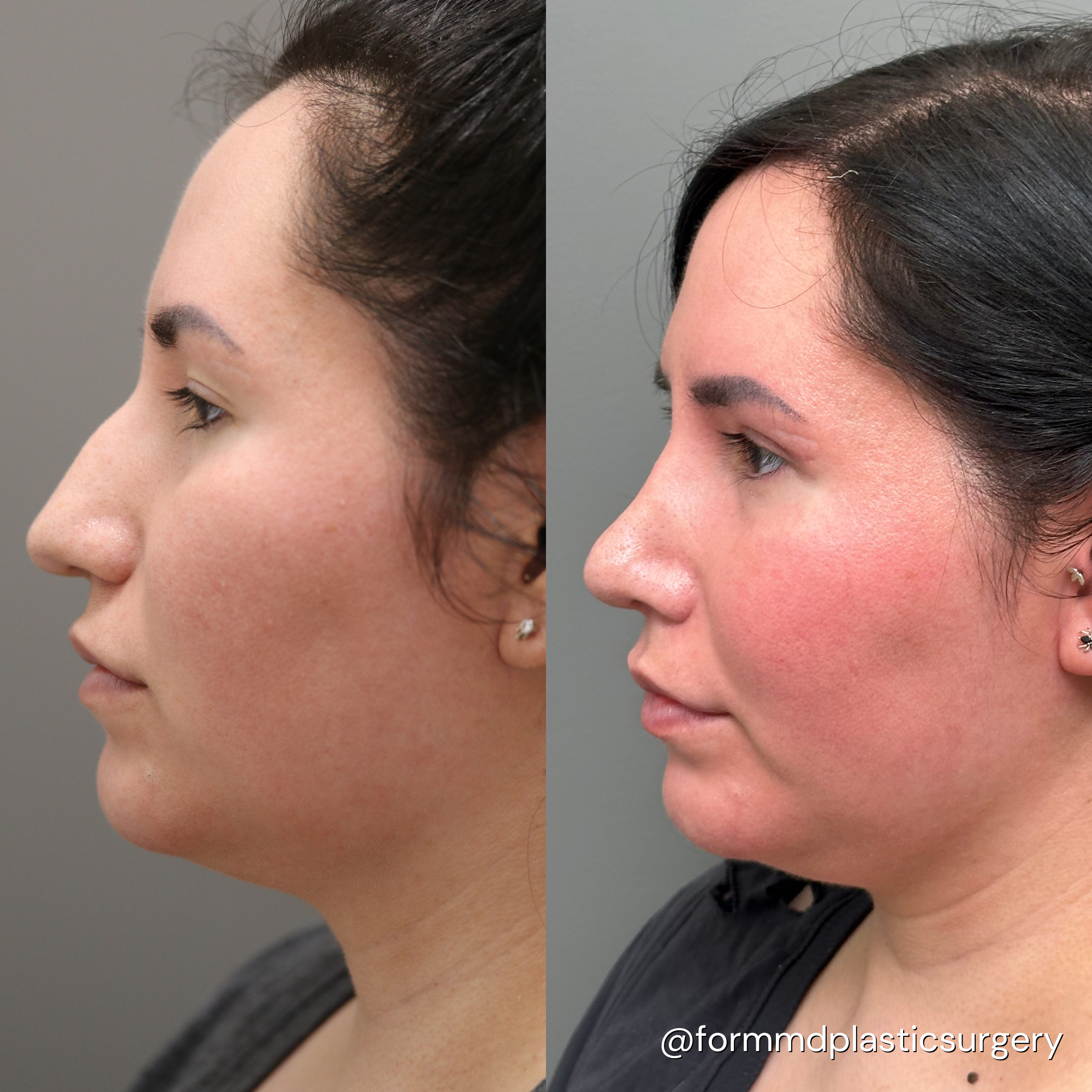 rhinoplasty results