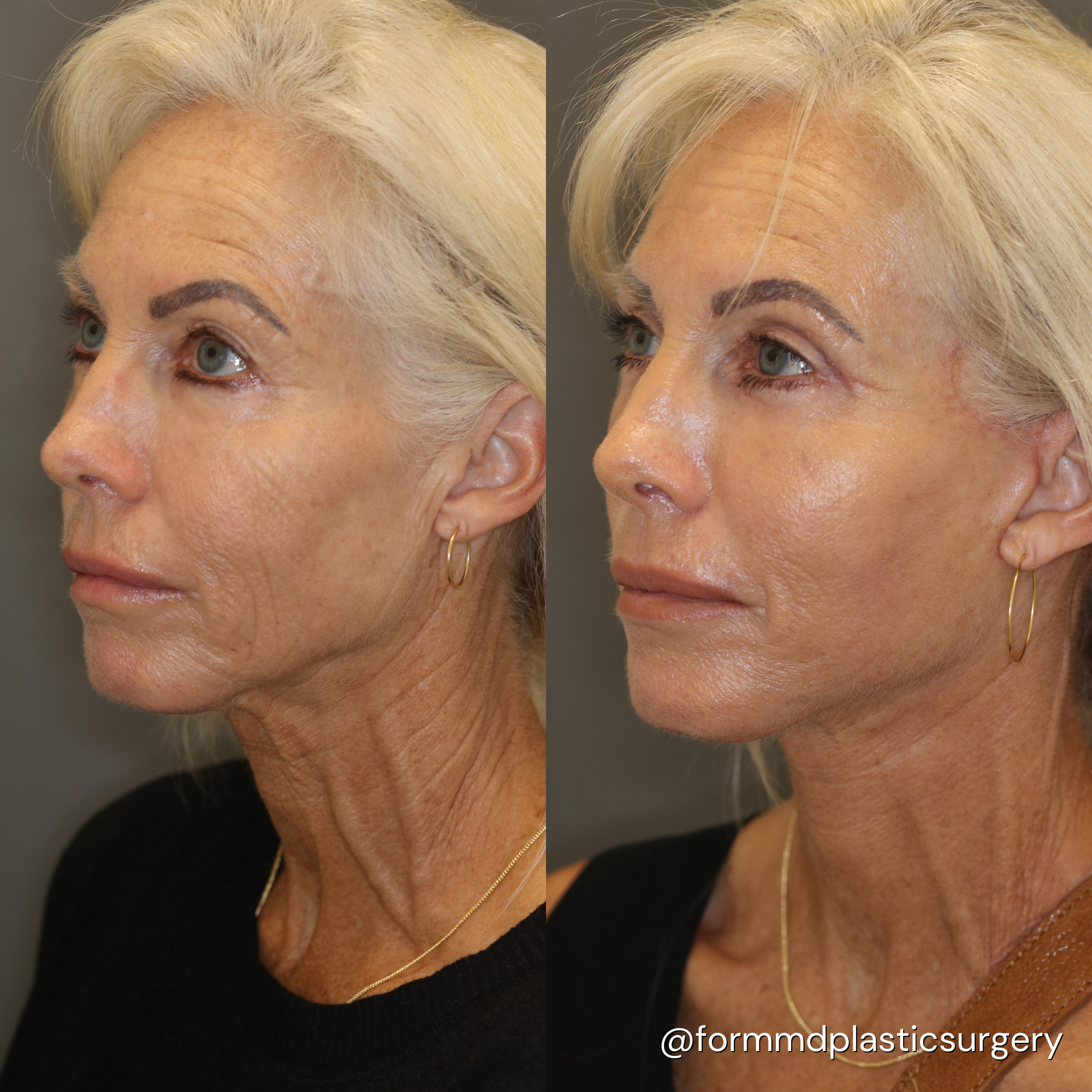 facelift results