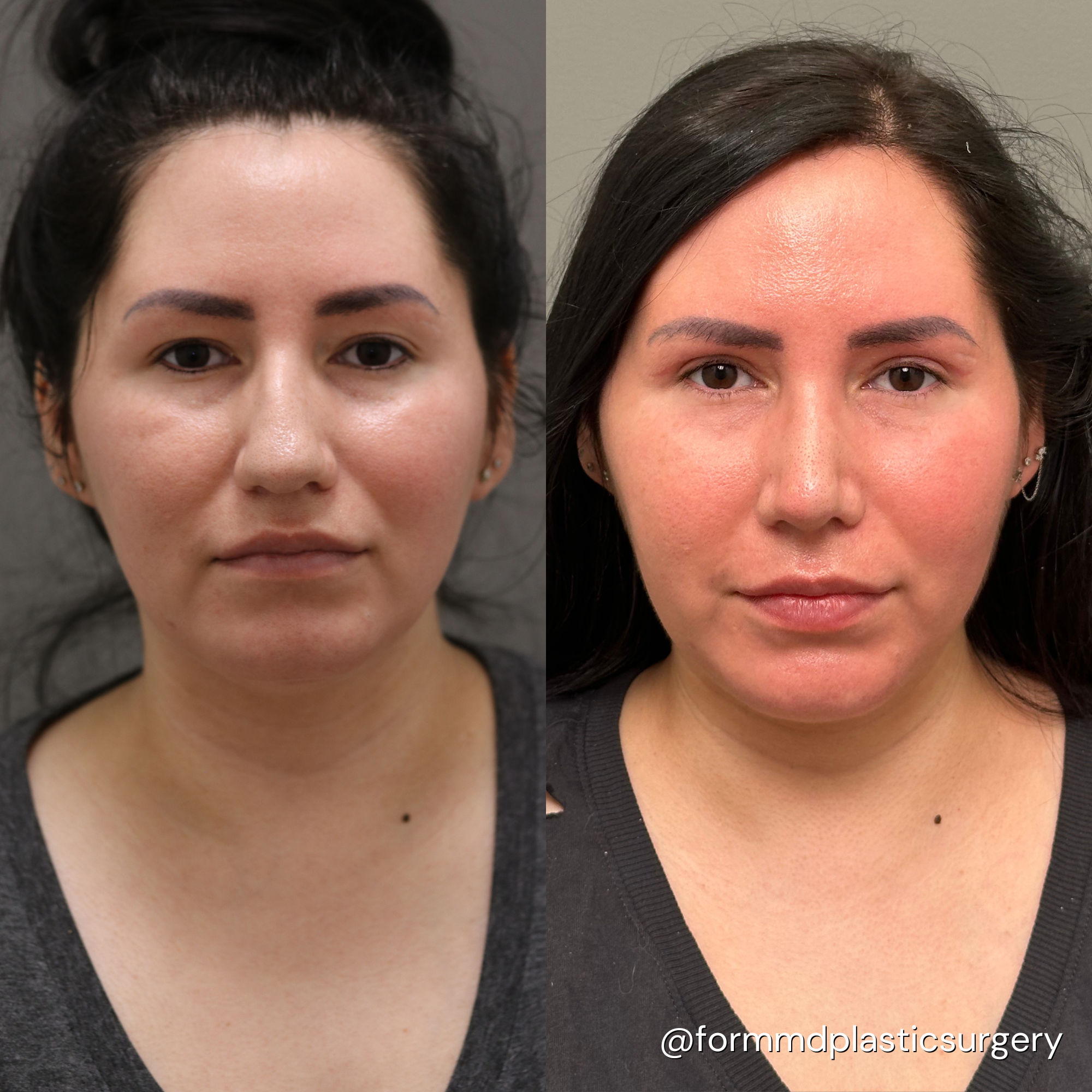 Dr Taylor Pollei rhinoplasty results