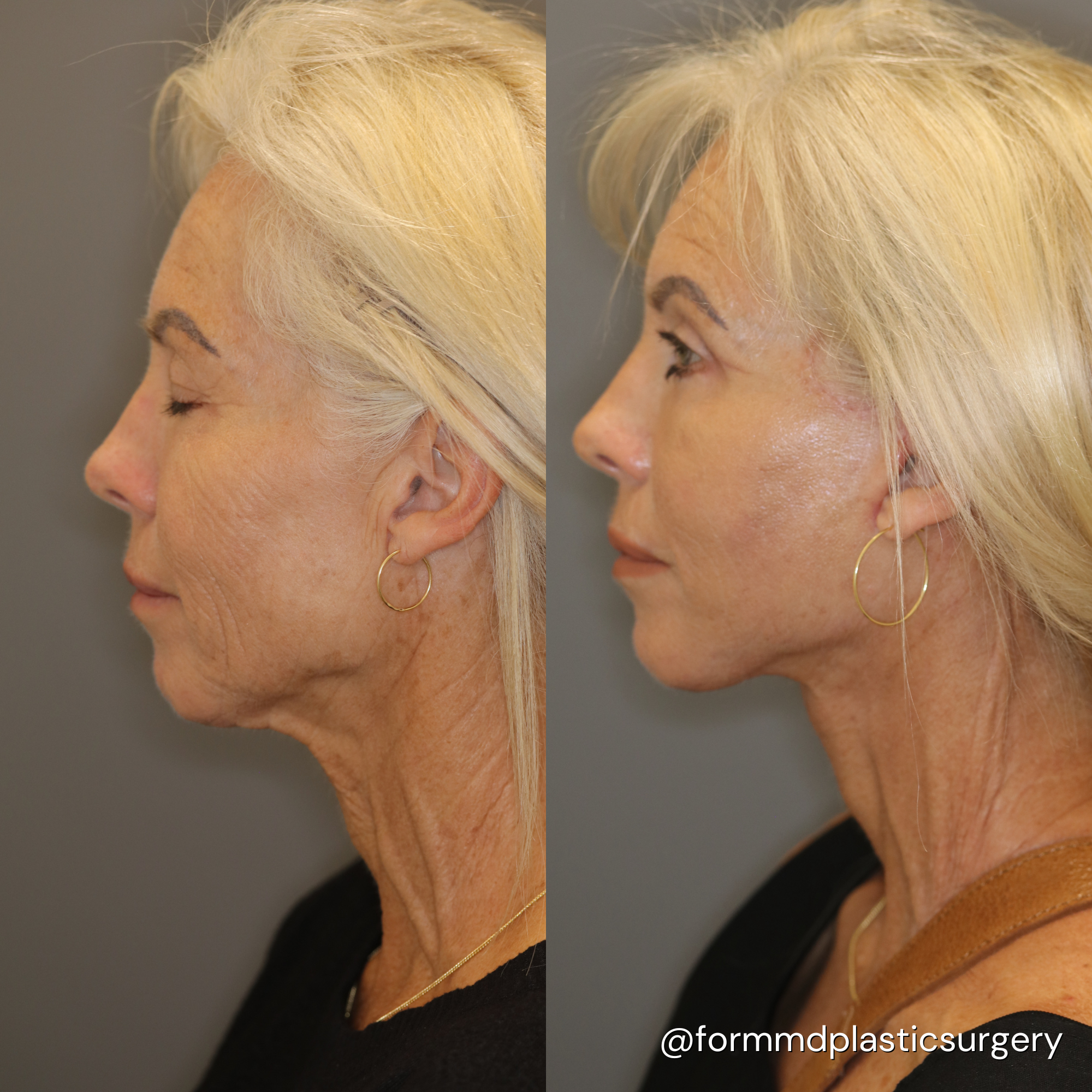 facelift results california