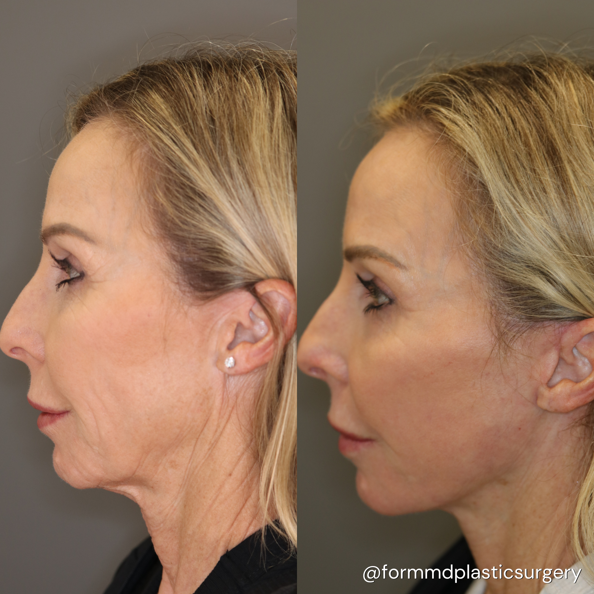 facelift surgery results