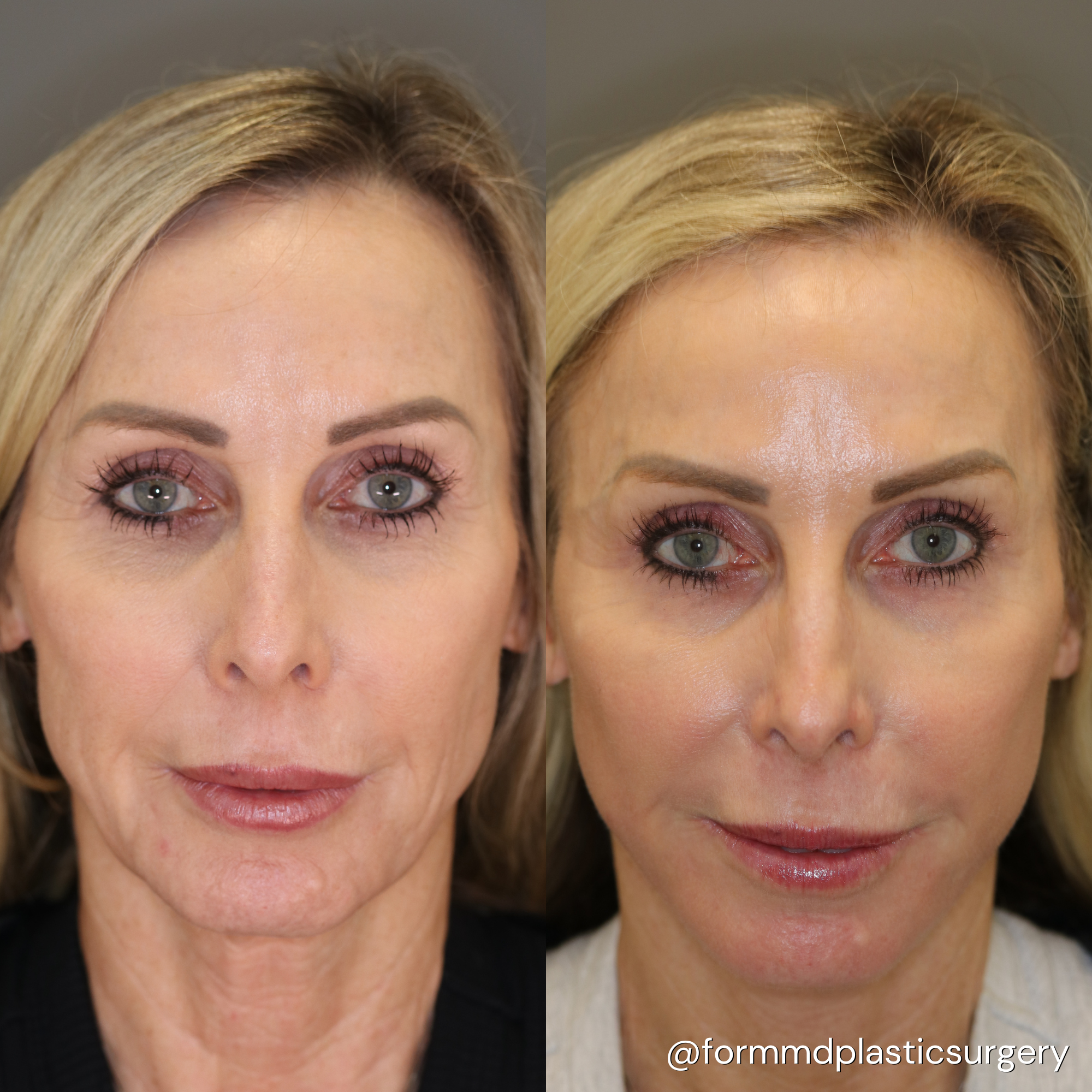 facelift surgery california