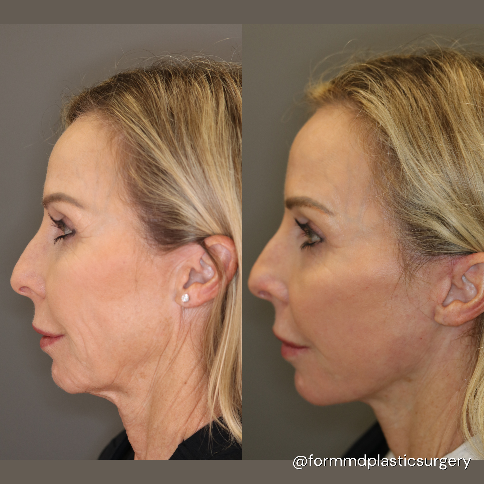 facelift surgery california