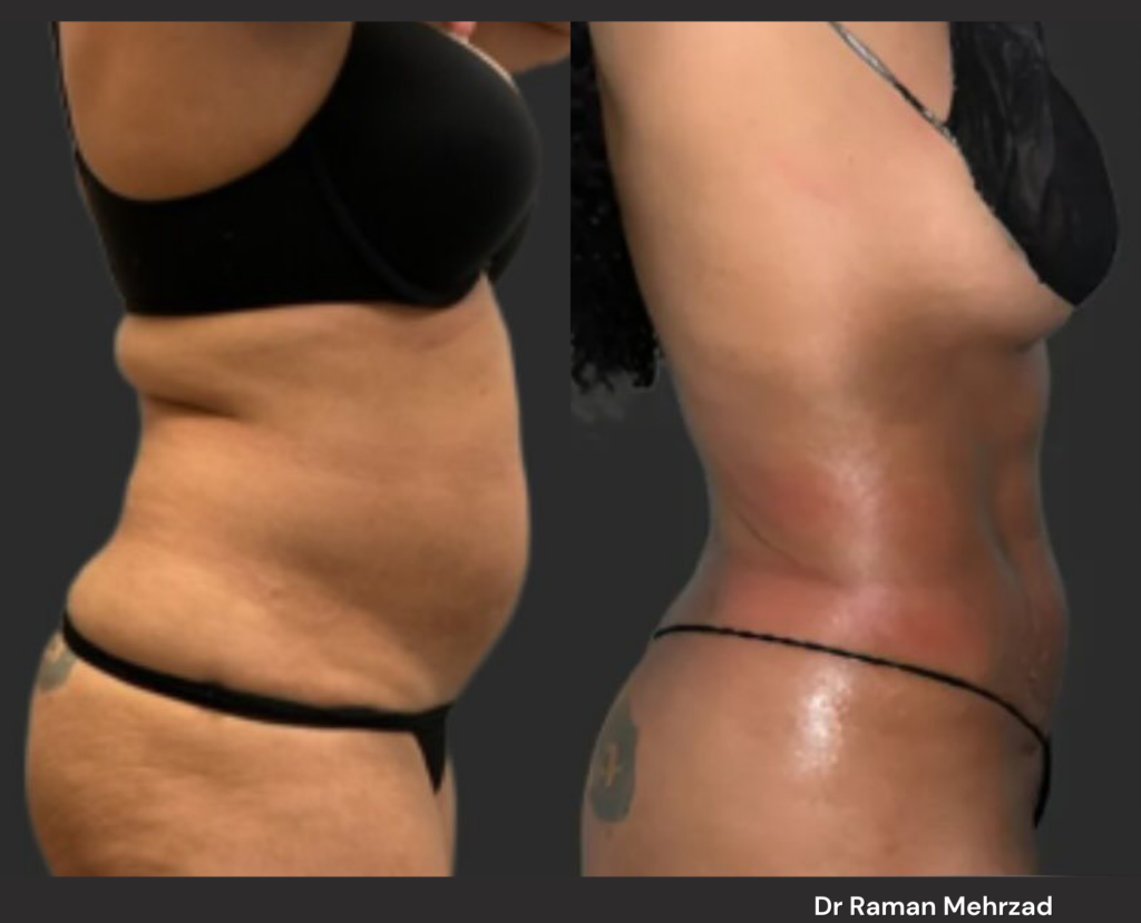 High definition liposuction