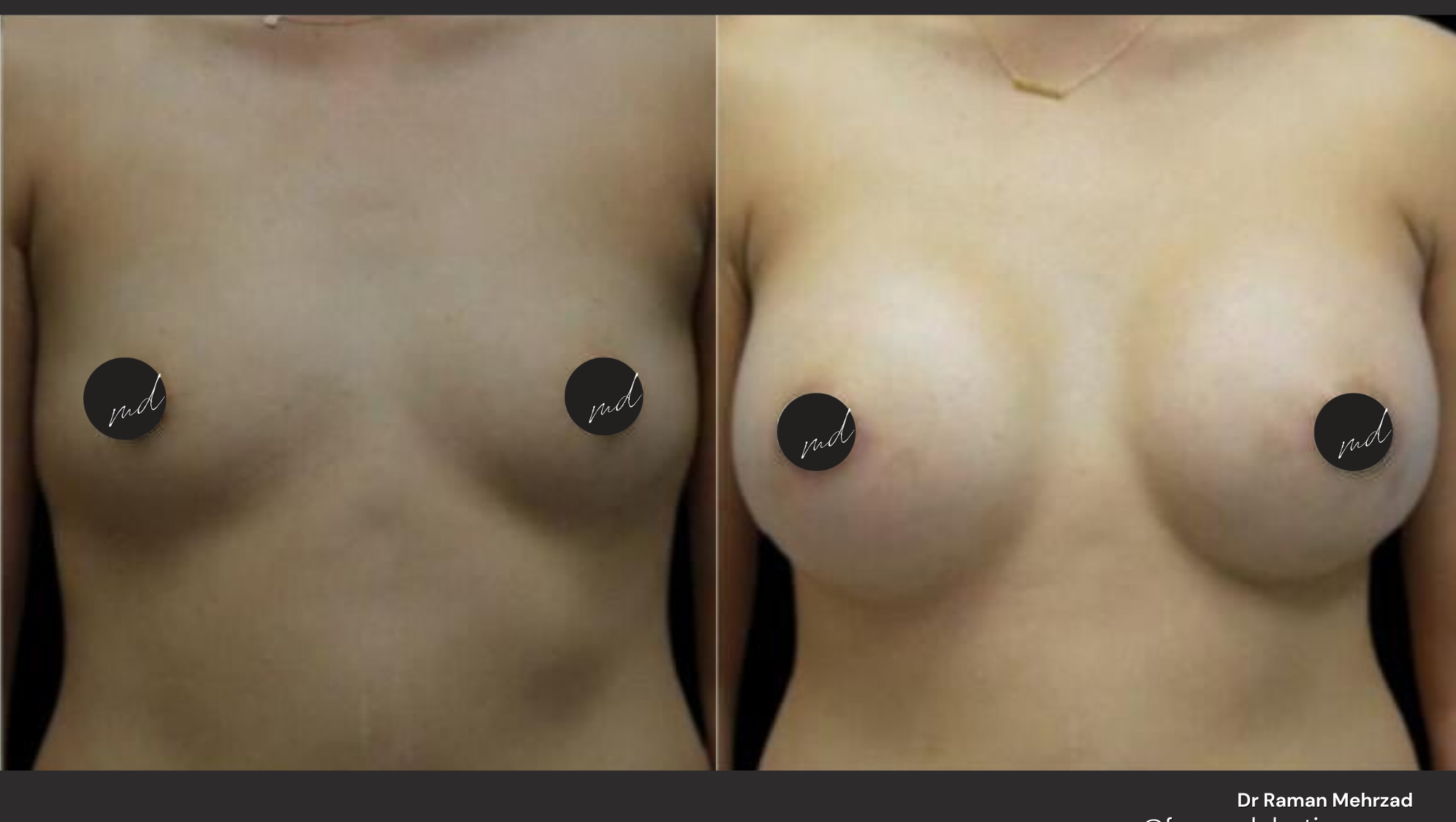 Scarless breast implant surgery