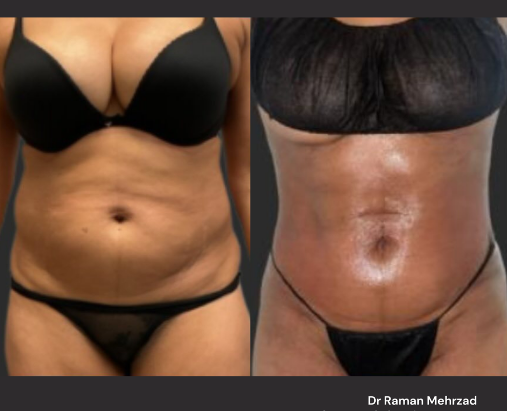 High definition liposuction