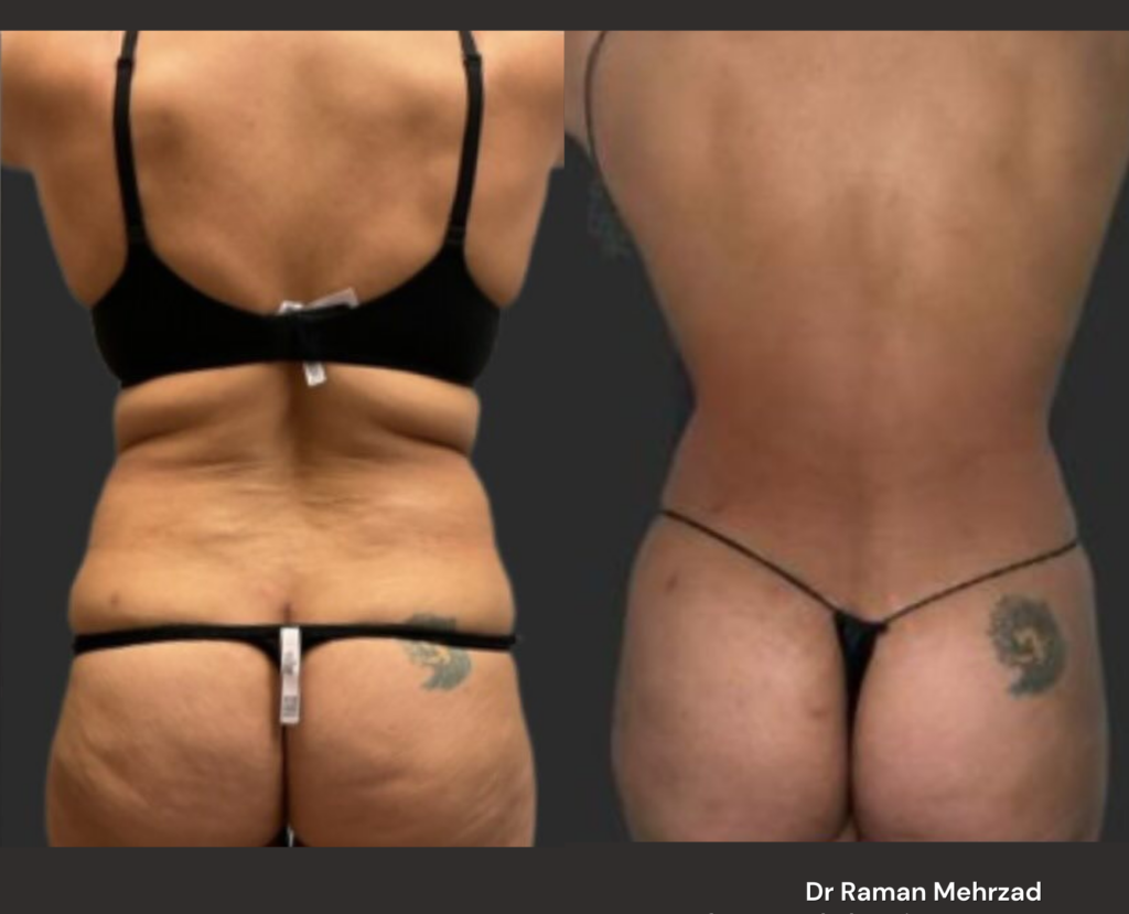 High definition liposuction